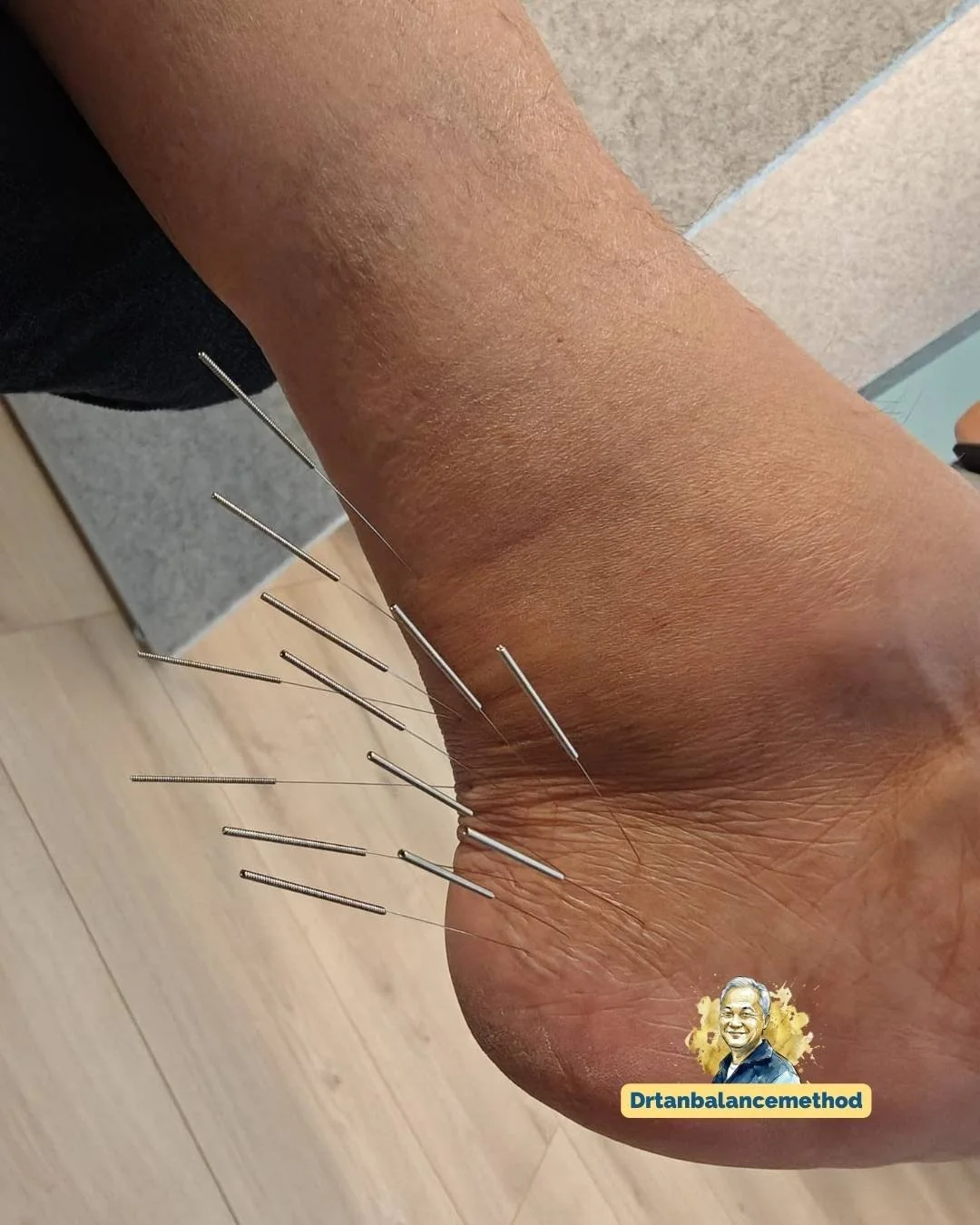 balance-method-foot-pain-toe-numbness-needling-3.jpg
