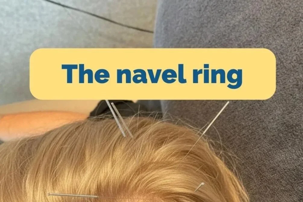 How to Treat Navel Pain with Dr. Tan's Balance Method: A Scalp Projection Case Study
