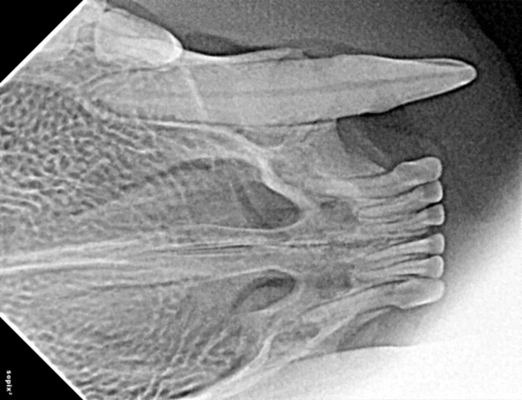 Black and white dental X-ray showing teeth, jawbone, and surrounding structures.