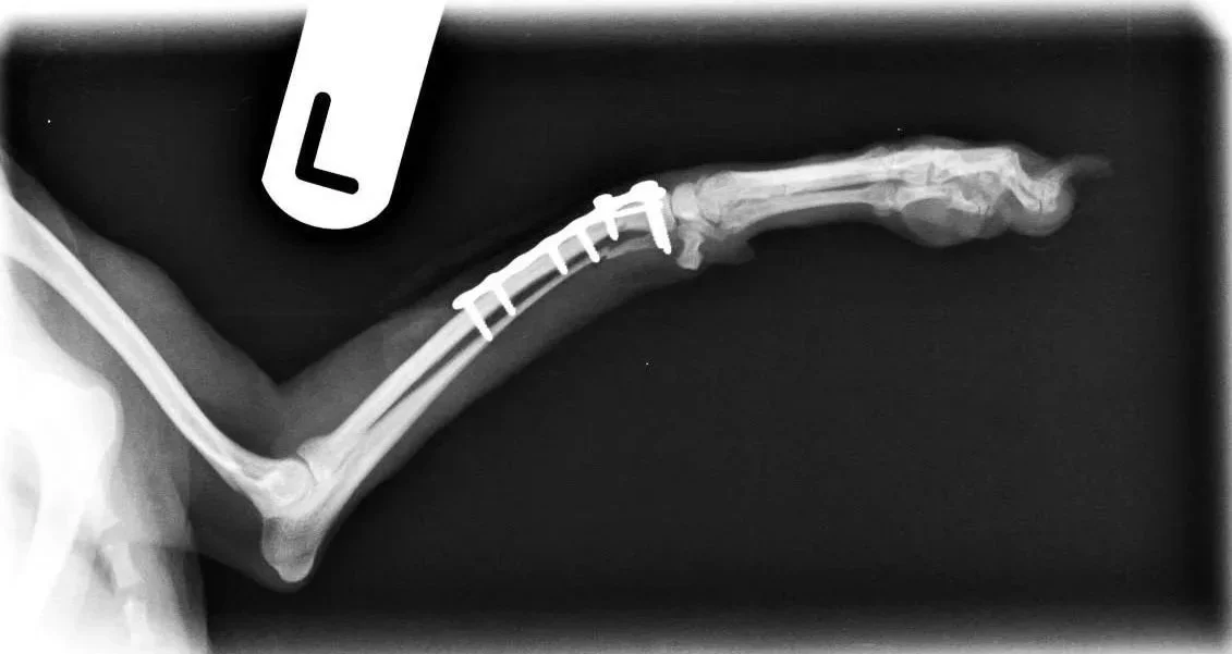 X-ray image of a human finger with a metal pin and screws used for medical fixation.