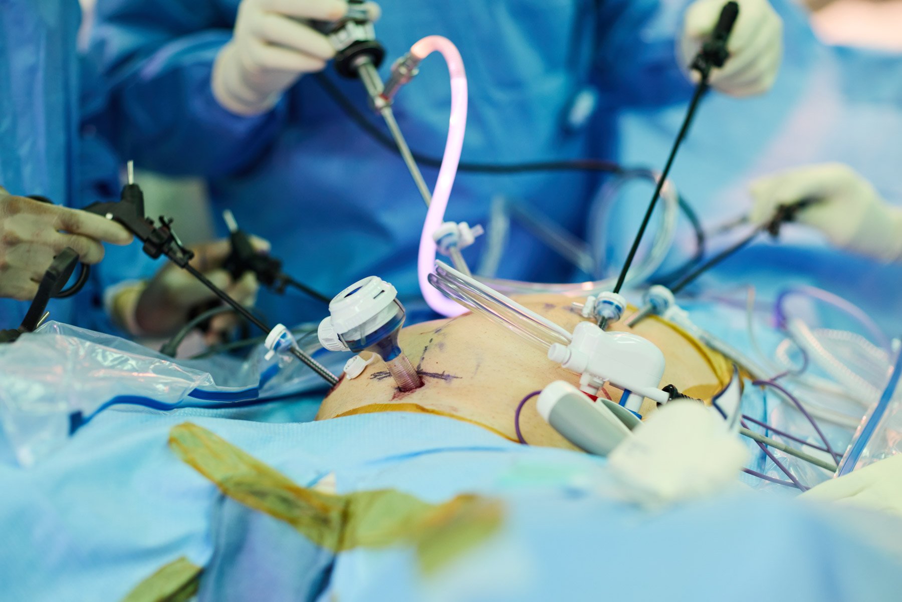 View of an endoscopic gastrointestinal surgical team performing an operation in an operating room, seen through a glass window with reflections, with medical monitors and equipment. At Mount Sinai hospital in New York City