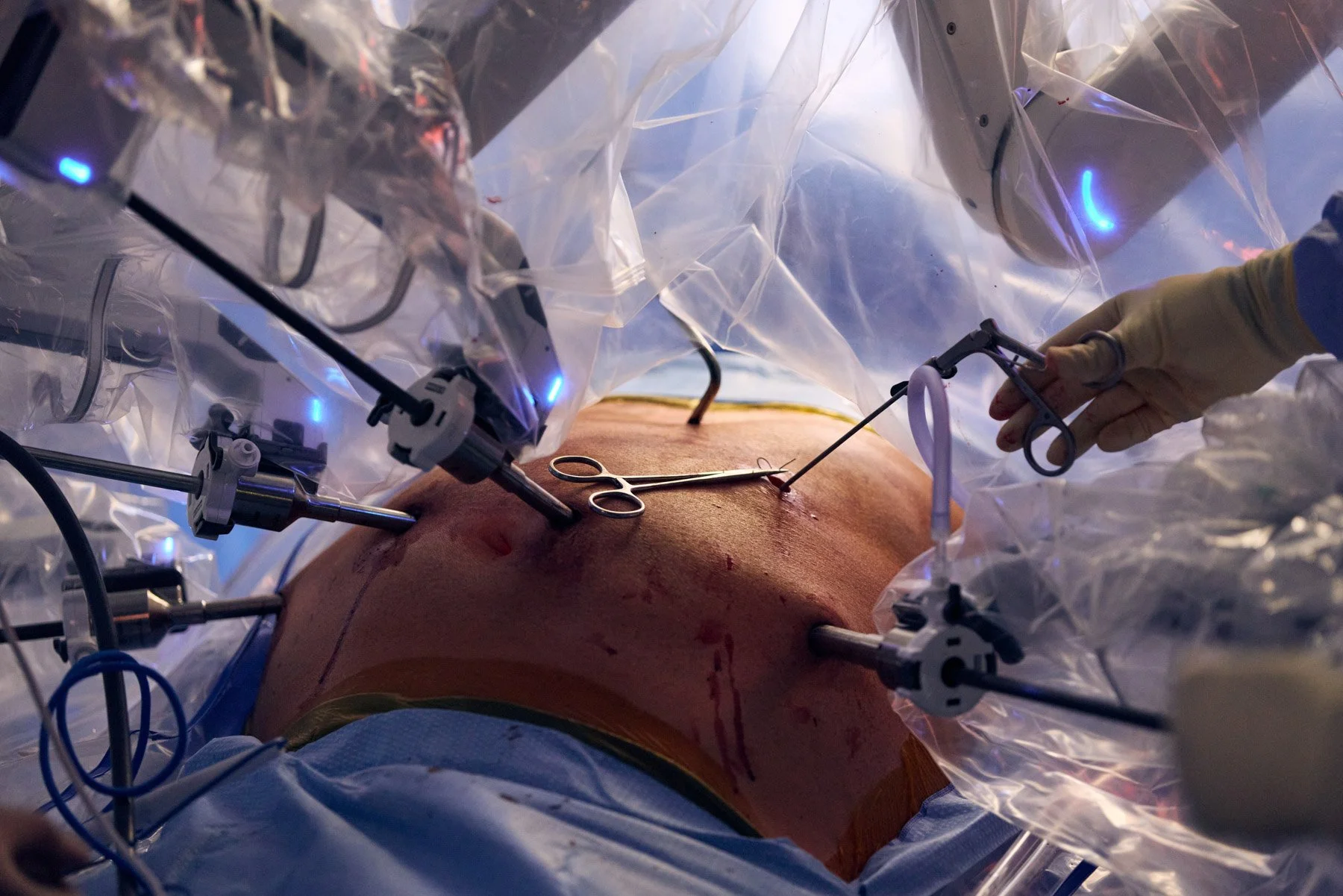 A patient undergoing surgery via the Davinci robotic assistance. At Mount Sinai Hospital in New York City