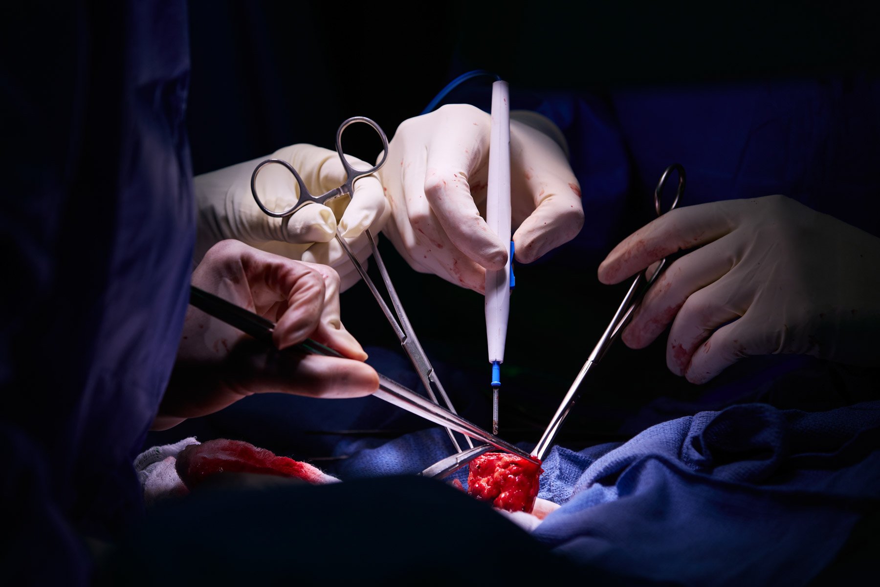 Close up of surgeons performing an operation with surgical tools in an operating room. At Mount Sinai hospital in New York City
