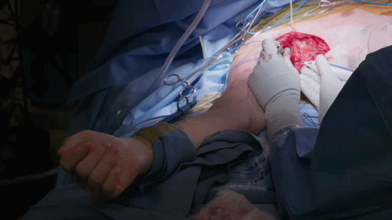 260213 Mount Sinai - NSICU Intercostal Nerves.gif