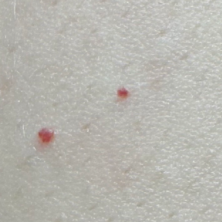 Close-up of human skin with two small red cherry angioma blemishes.