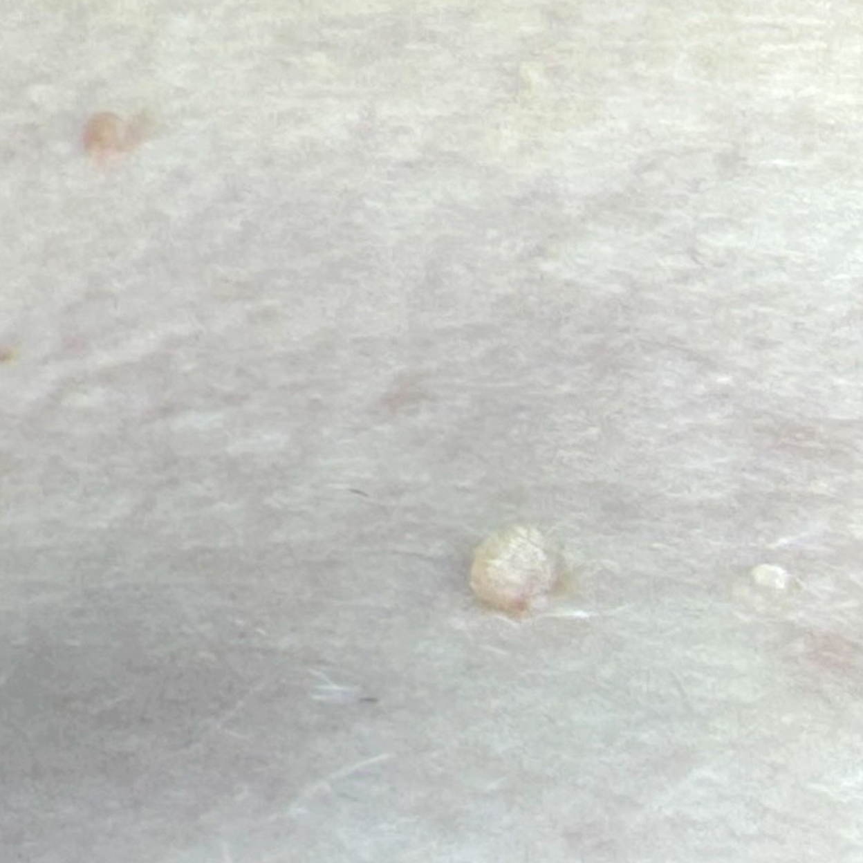Close-up of a fair-coloured skin with small skin tags and blemishes.