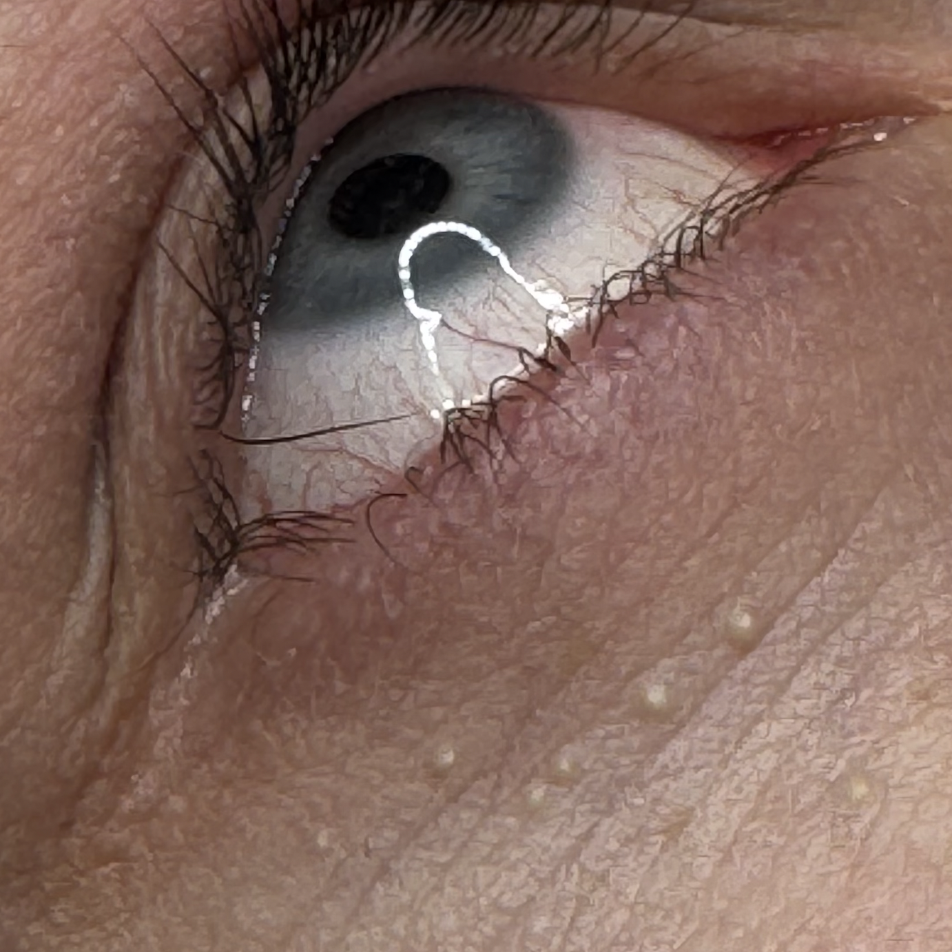 Close-up of a human eye (with eyelashes, showing the iris, pupil, and reflection of a bright light source) and milia cysts under the eye.