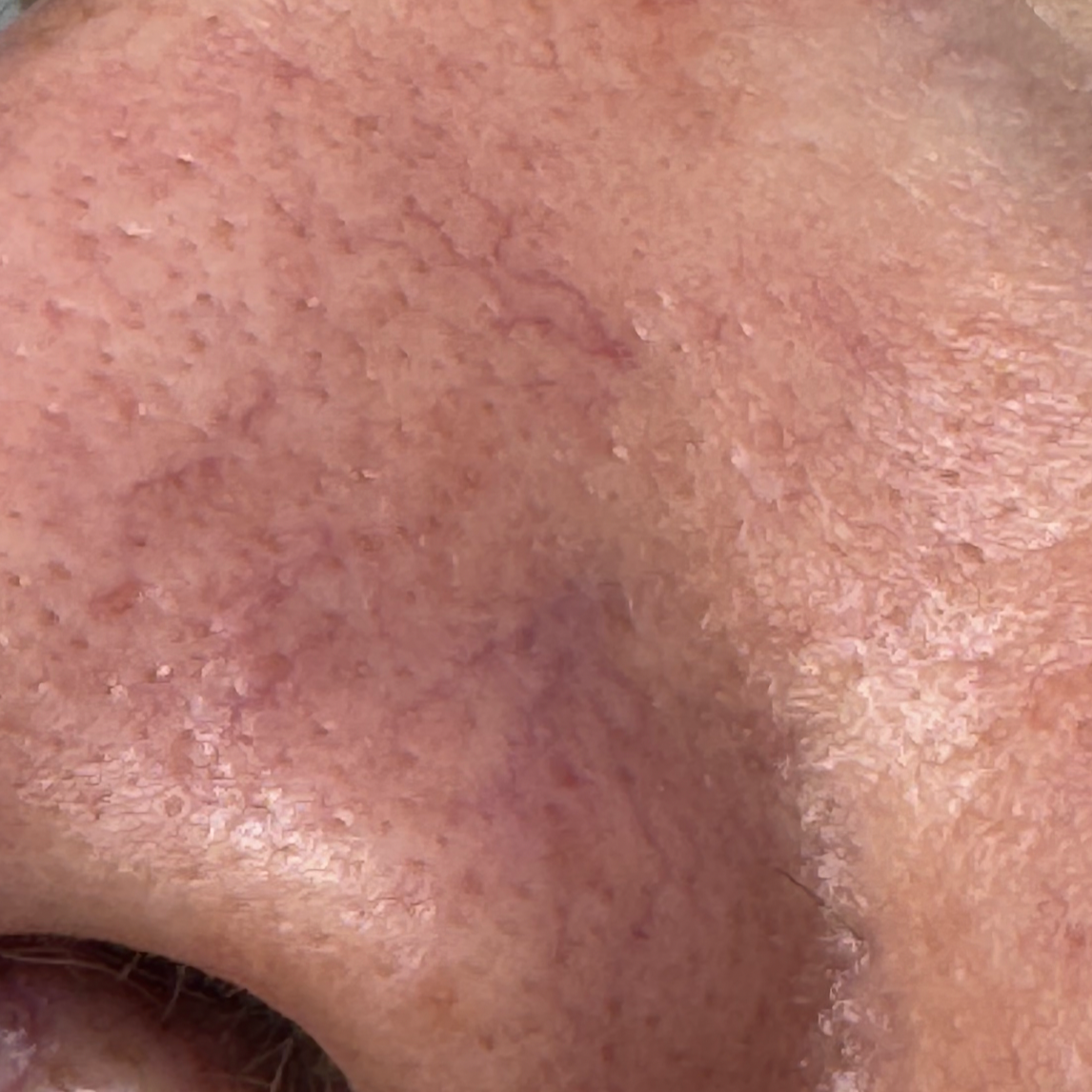 Close-up of a human nose showing red thread veins, skin texture and pores.