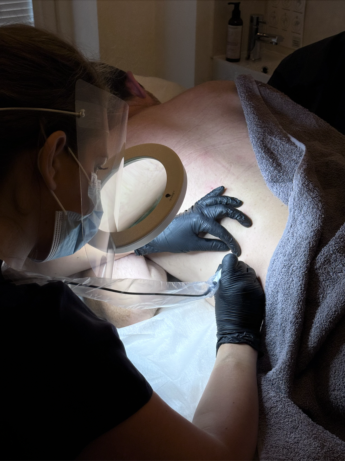 Advanced electrologist Gemma Pinfield-Thomas is wearing gloves, a mask, and face shield, treating cherry angiomas (blood spots) on a patient's lower back with a magnifying glass in a clinical setting.