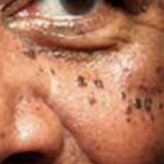 Close-up of a human eye with dermatosis papulosa nigra skin blemishes beneath.
