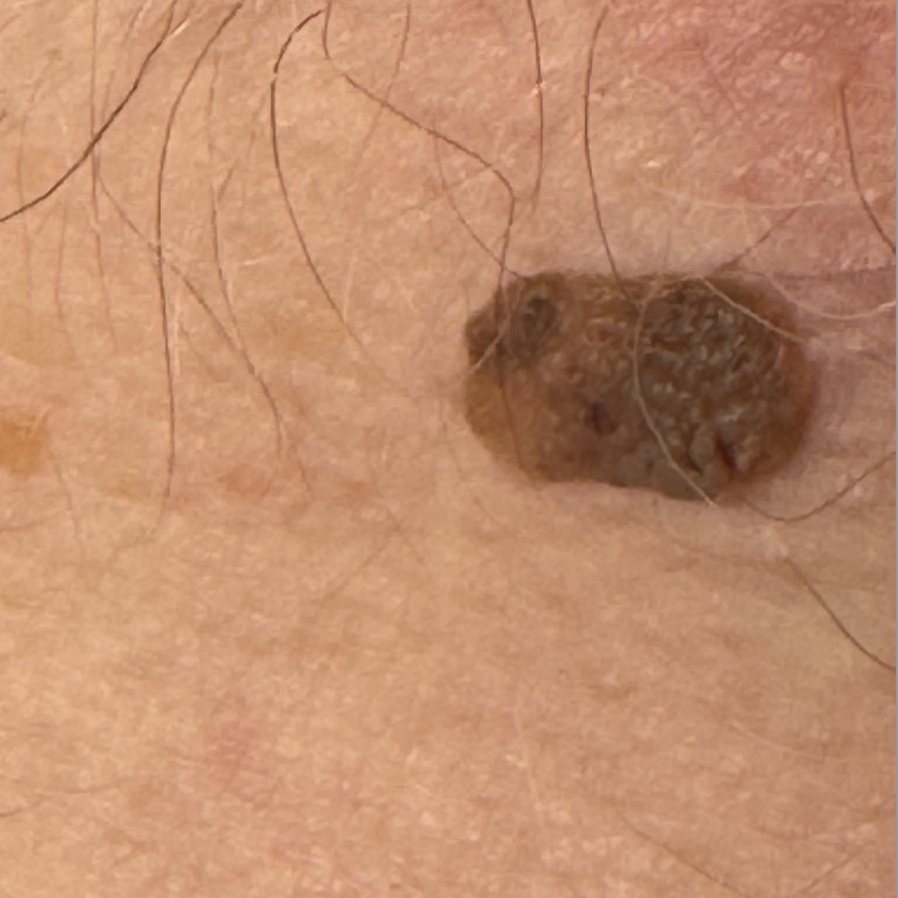 A close-up of human skin with hair and a seborrhoeic keratosis.