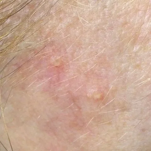 Close-up of light skin with sebaceous hyperplasia and redness.