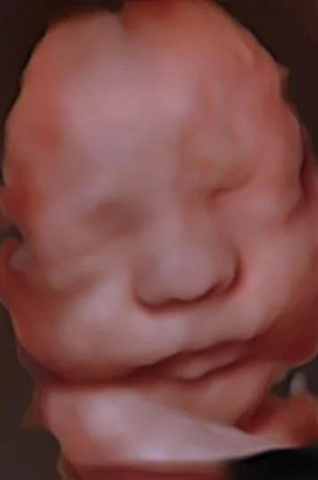 3D ultrasound moment