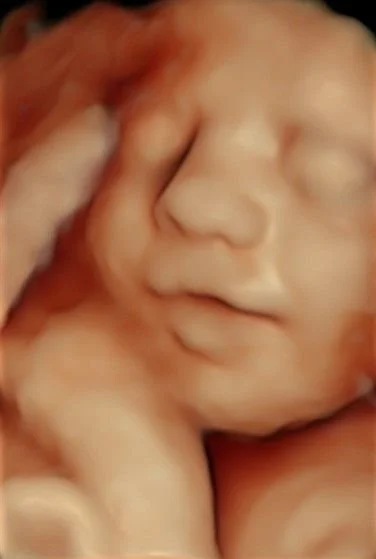 3D ultrasound moment