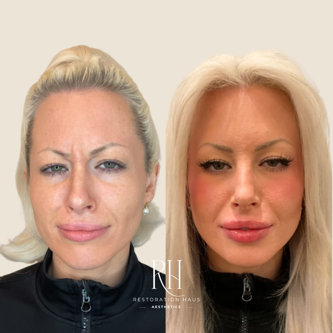 Comparison photo showing a woman before and after cosmetic enhancement, with the left side displaying a more natural appearance and the right side showing a more refined and enhanced look. The woman has blonde hair and is wearing a black zip-up top in both images, with a neutral background and the logo 'Restoration Haus Aesthetics' at the bottom.