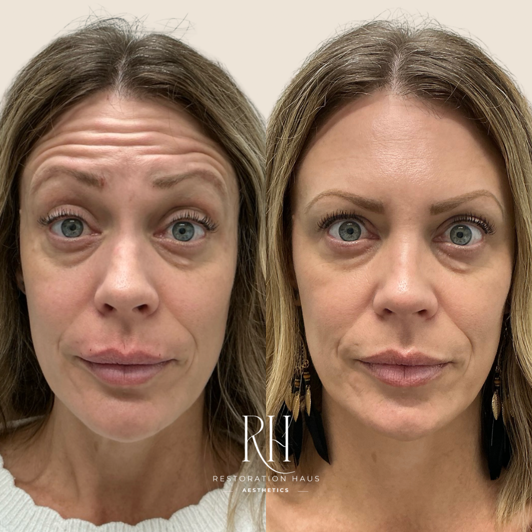 Side-by-side comparison of a woman's face before and after cosmetic treatment, showing reduced wrinkles and improved skin smoothness.