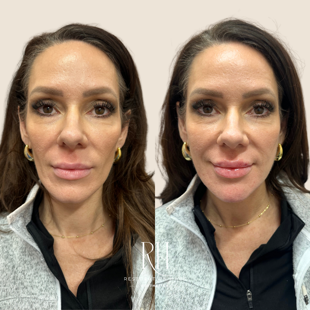 Side-by-side comparison of a woman's face before and after cosmetic treatment of hyper dilute Radiesse biostimulation