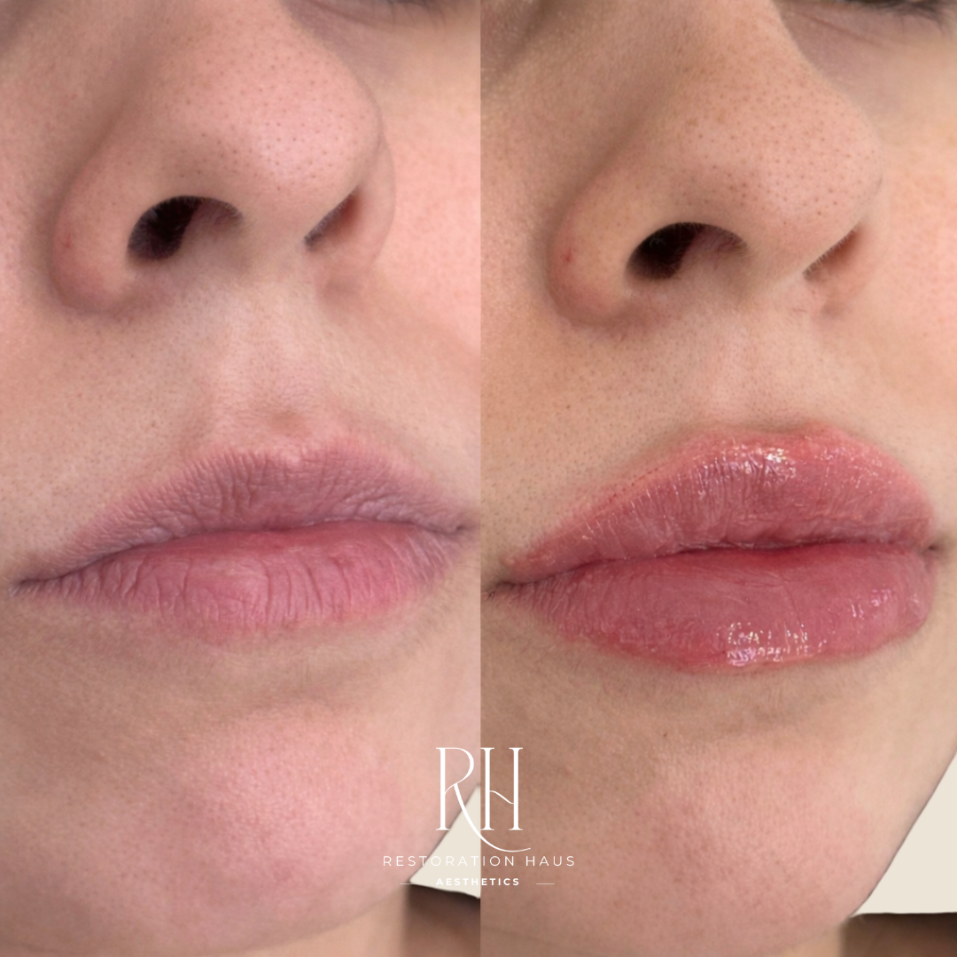 Close-up of a person's face showing a before and after comparison of lip enhancement, with the right side featuring glossier, fuller lips.
