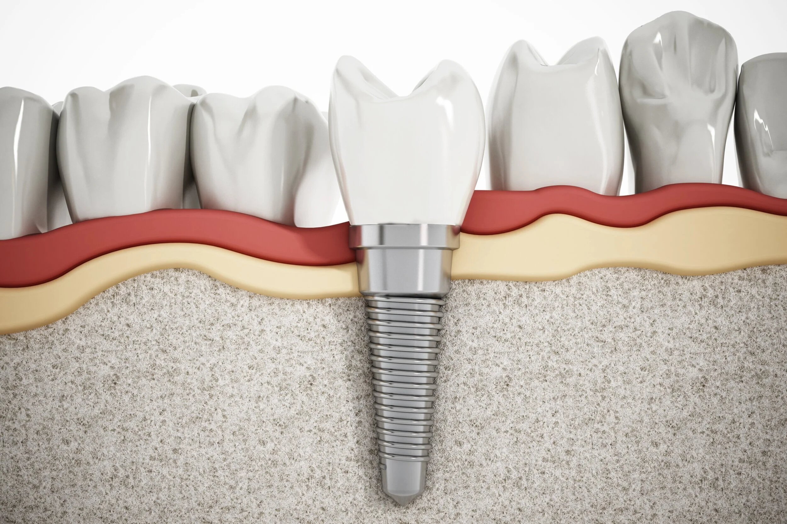 dental implants