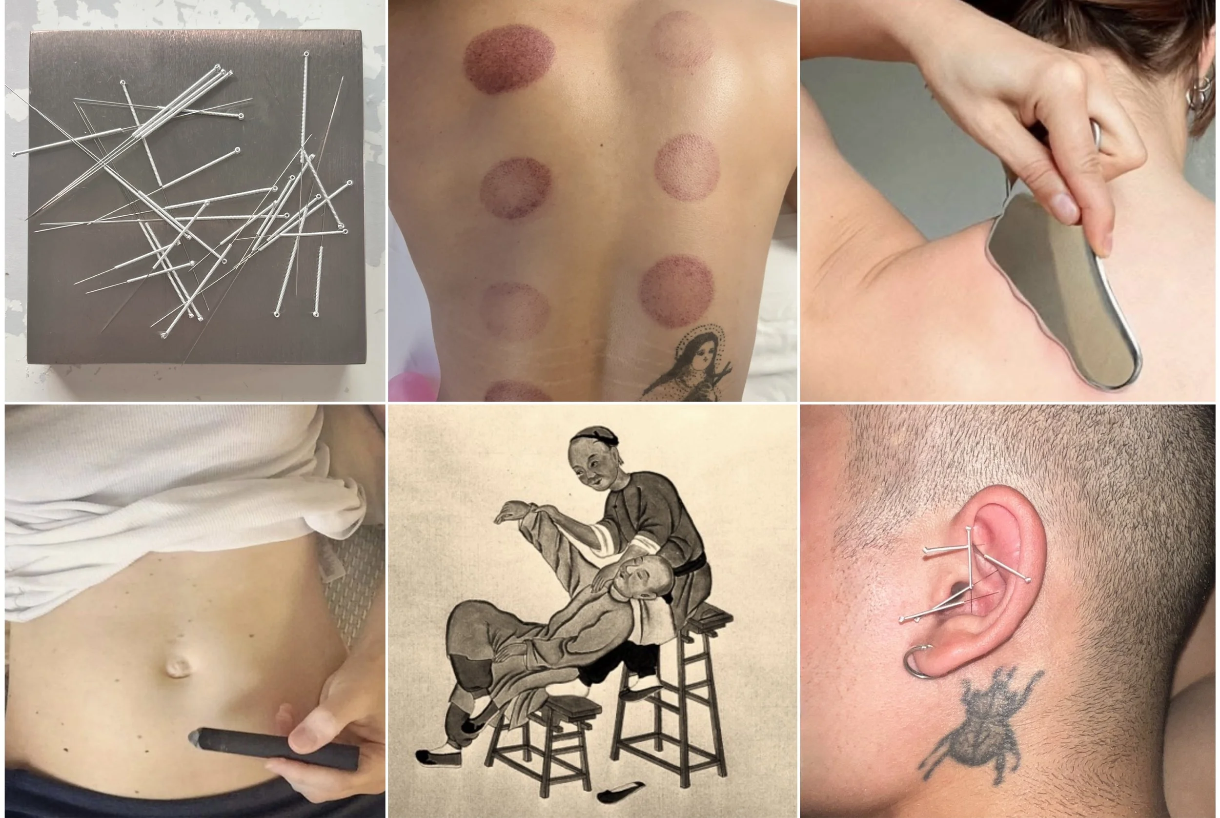 Une collection d'image montrant diverses modalités et outils d'acupuncture et de médecine chinoise, des aiguilles d'acupuncture, des ronds mauves dû aux ventouses, un bâton de moxa appliqué au niveau du bas ventre , auriculothérapie NADA.