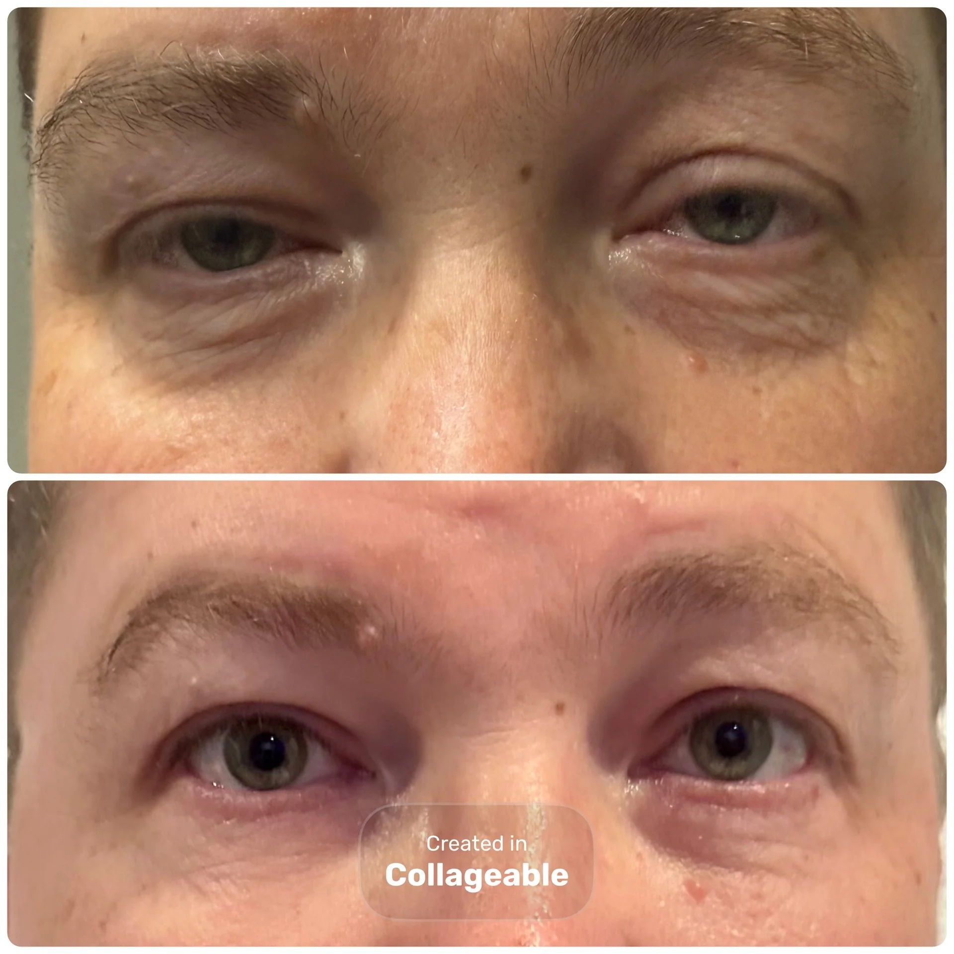 Botox / Dysport (Full Face)