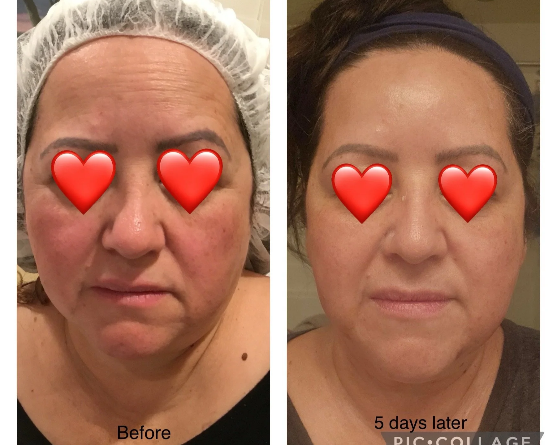 Side-by-side comparison of a woman's face before and five days after a skincare treatment. The left image shows a woman with redness, uneven skin tone, and facial blemishes, wearing a hairnet. The right image shows the same woman with clearer skin, less redness, and a more even tone, wearing a headband. Both images have red heart emojis over the eyes.