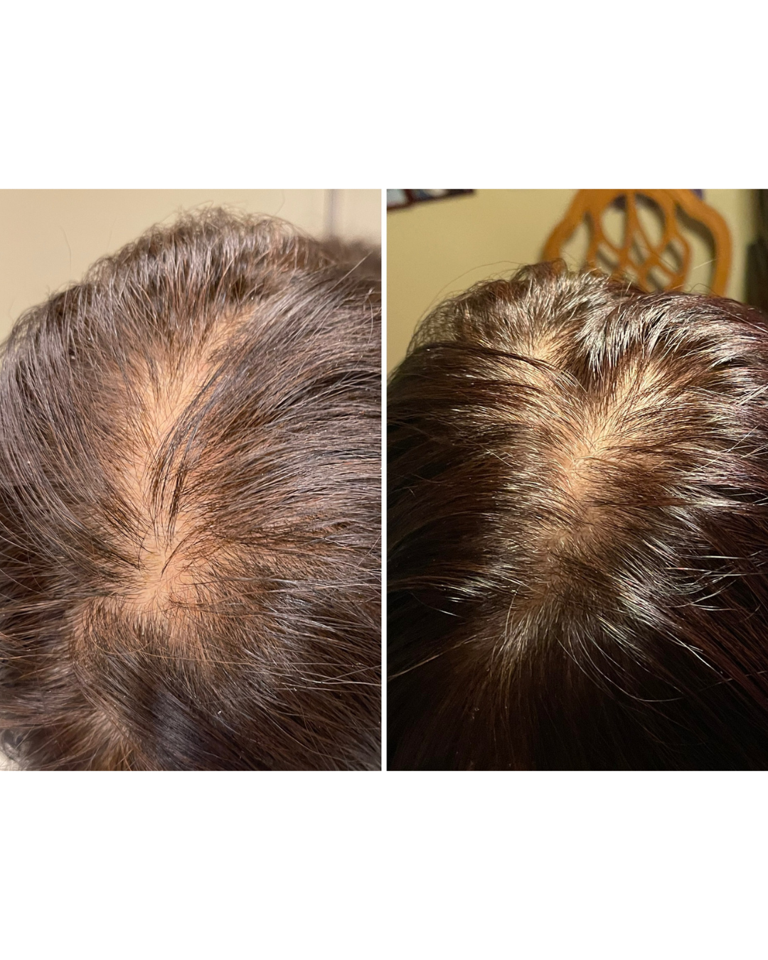 Comparison of a person's scalp before and after hair treatment, showing increased hair density and reduced scalp visibility.