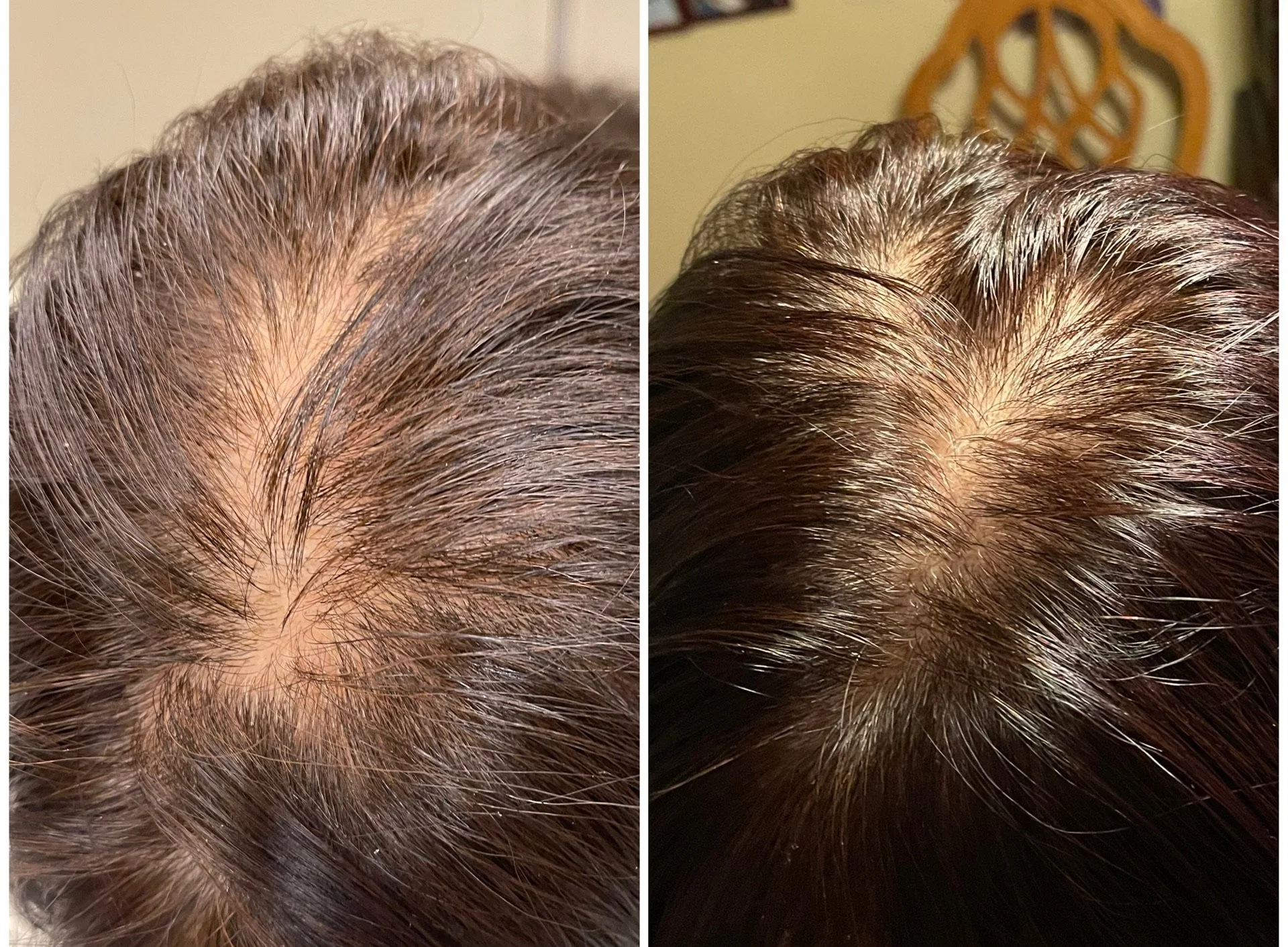 PRP for Hair & Skin with Microneedling