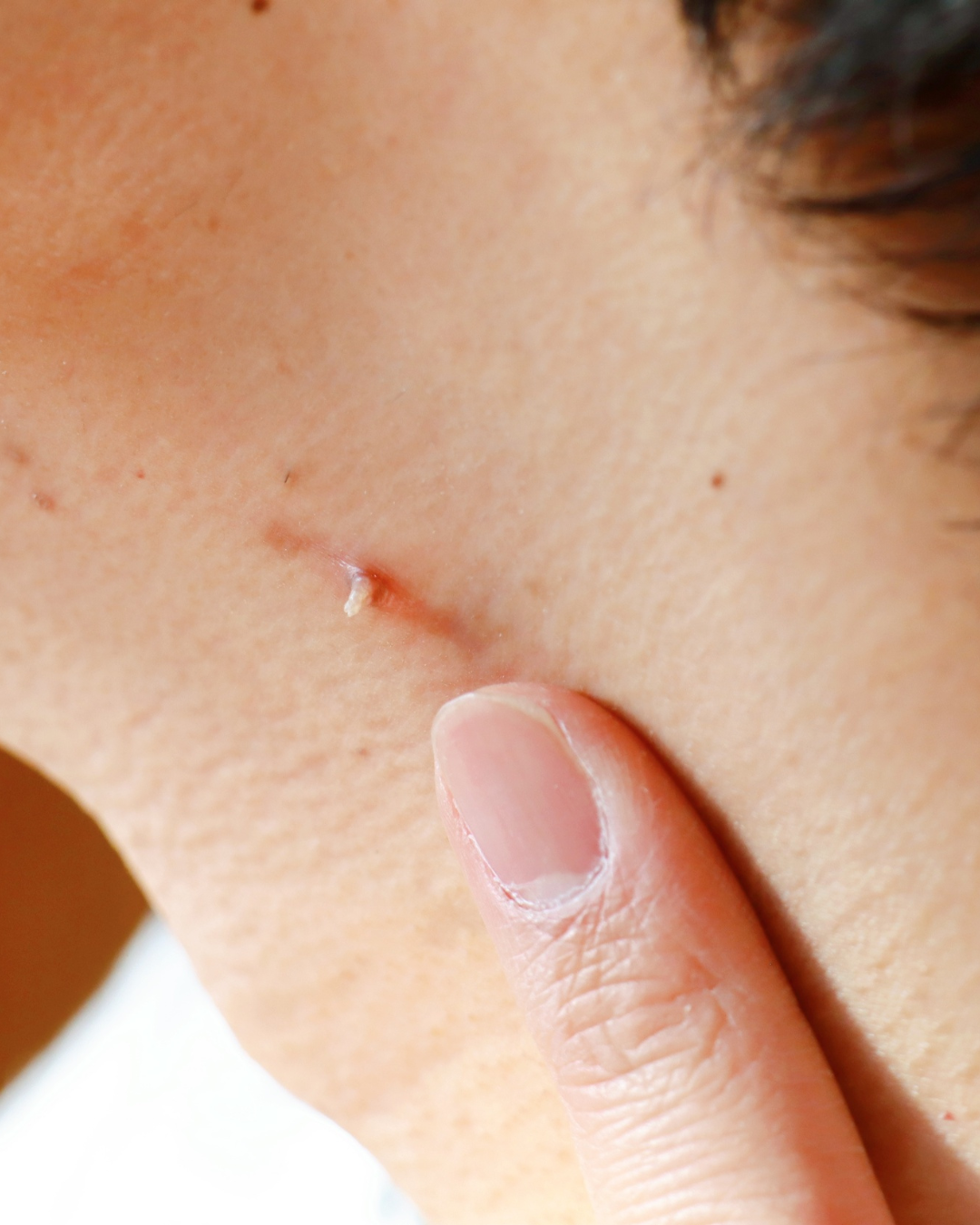 Wart / Skin Tag Removal
