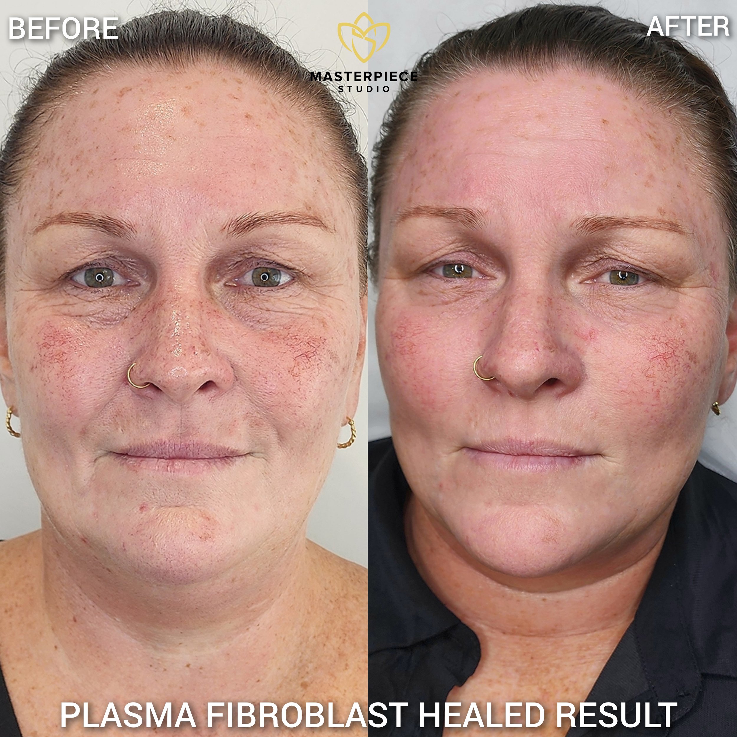 HEALED PLASMA FIBROBLAST RESULT TOWNSVILLE