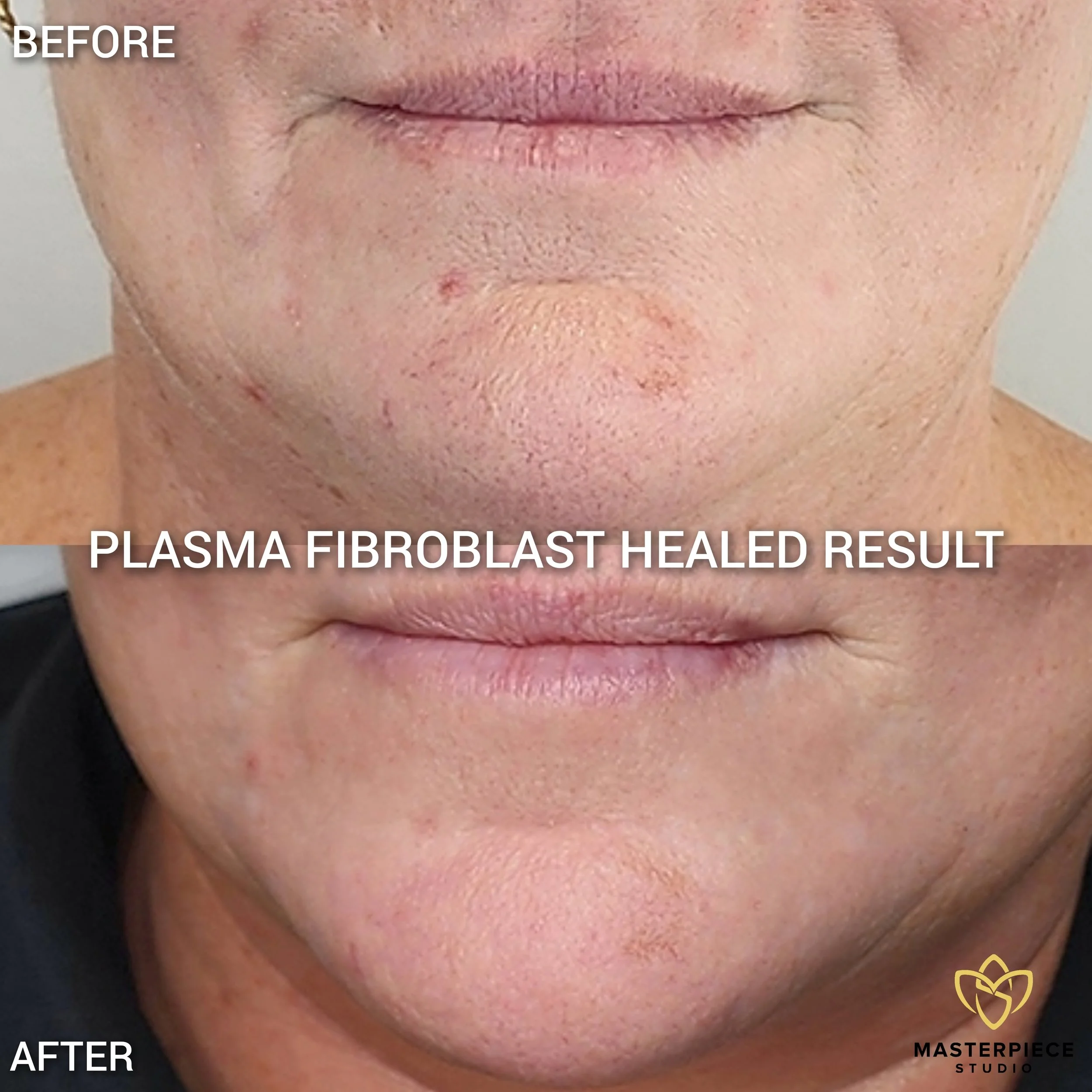 HEALED PLASMA FIBROBLAST RESULT TOWNSVILLE
