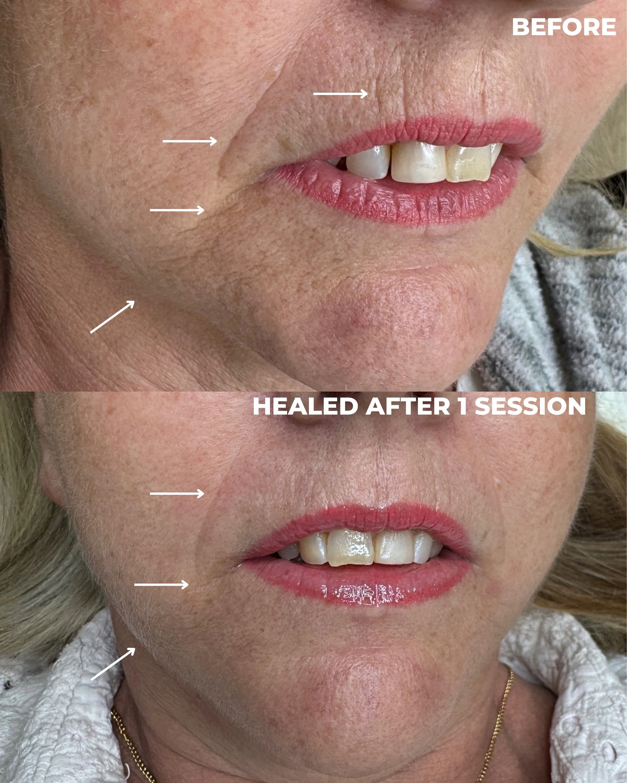 SKIN TIGHTENING TOWNSVILLE