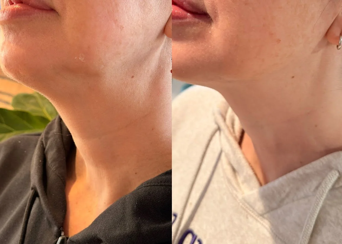 Close-up of a person's neck and lower face, showing before and after skin improvement pictures.
