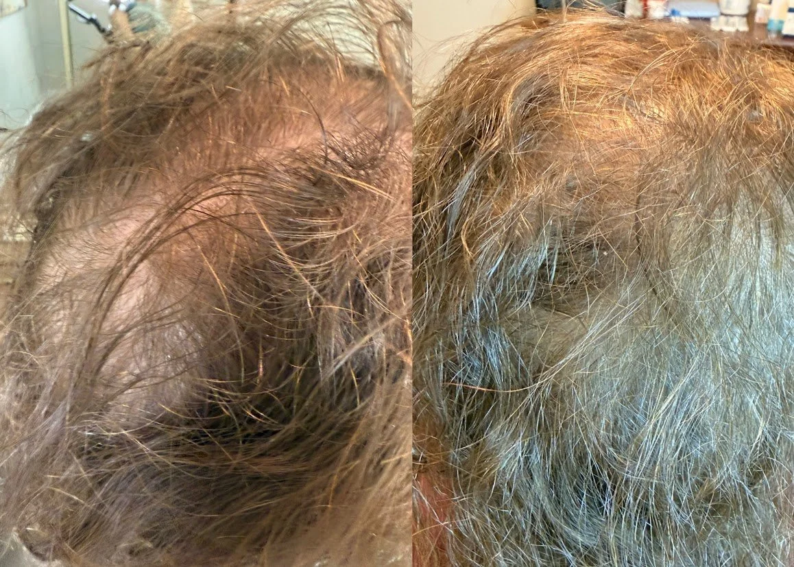 Comparison of a person's scalp before and after hair treatment showing improved hair density and reduced hair loss on the right side.