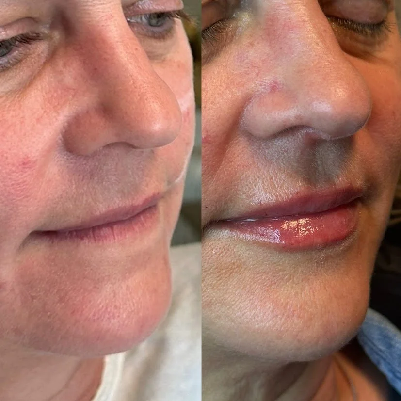 Close-up of a man's face showing before and after skin treatment, demonstrating improved skin texture and appearance.