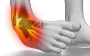 Lateral Ankle Sprain