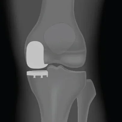 protesi monocompartimentale ginocchio