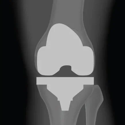 Protesi totale ginocchio