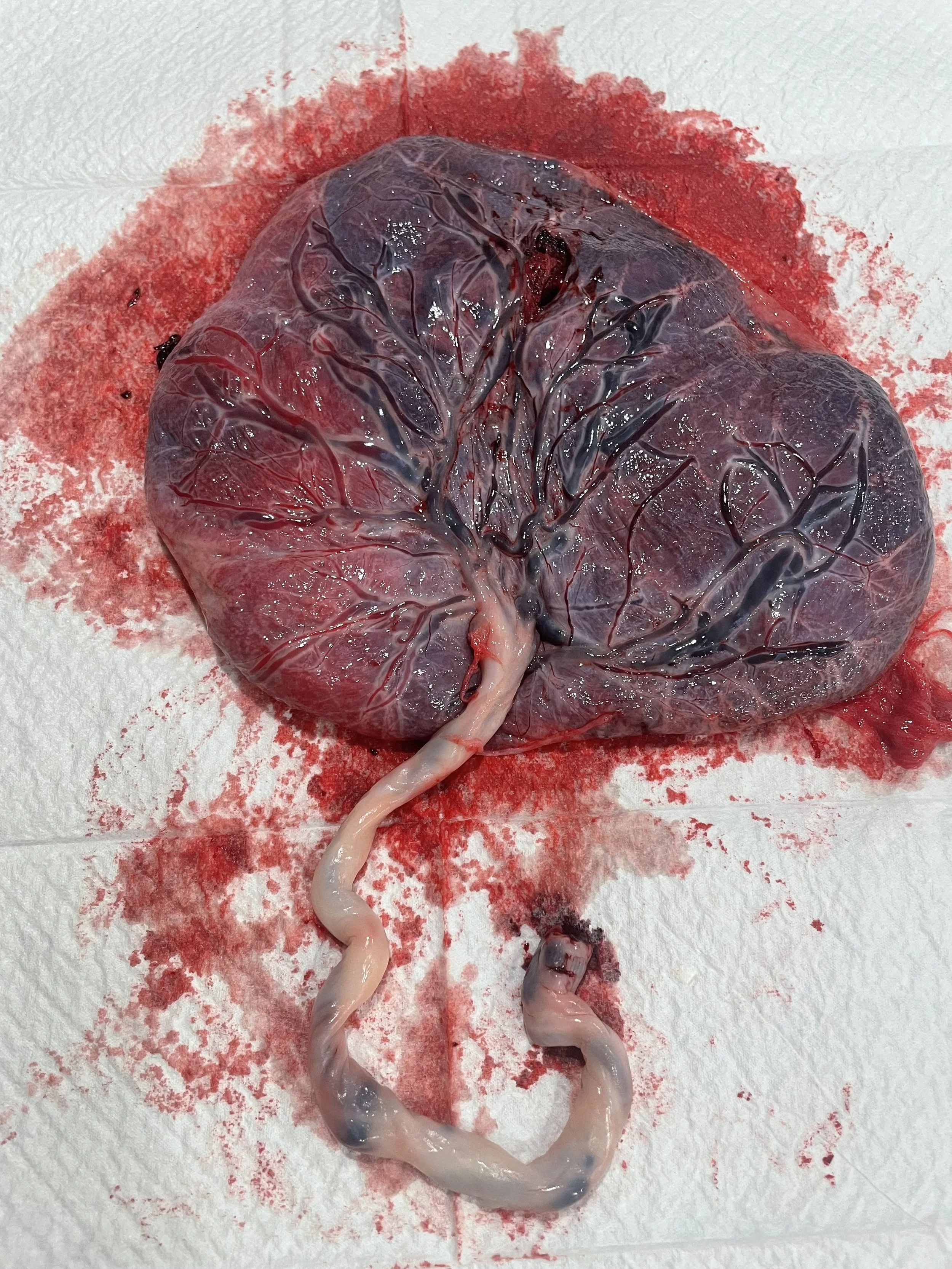Freshly extracted placenta and umbilical cord on white surface with blood and tissue.