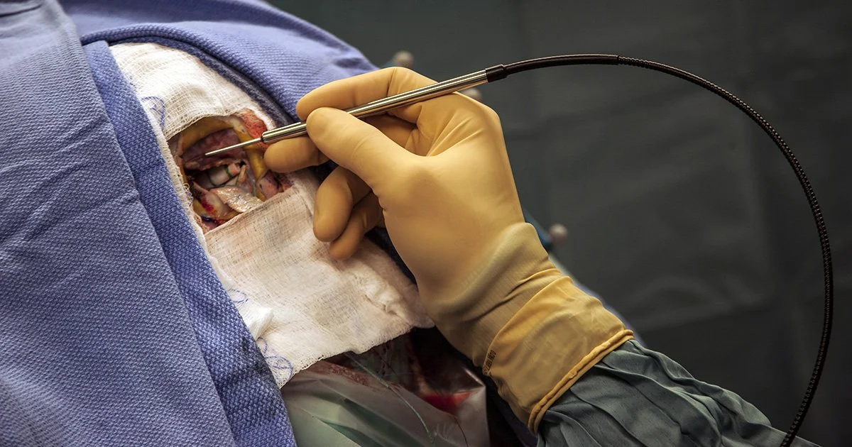 A surgical probe developed at Polytechnique Montréal