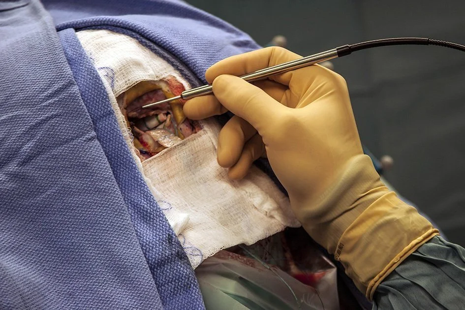 Chirurgie du cancer : une sonde pour améliorer le pronostic en cancer du cerveau et du sein