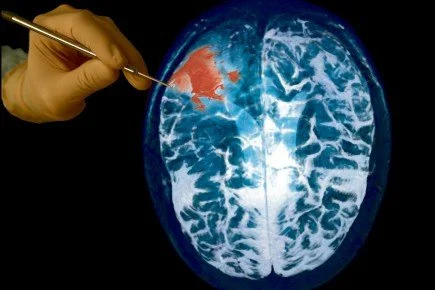 Probe in front of a brain