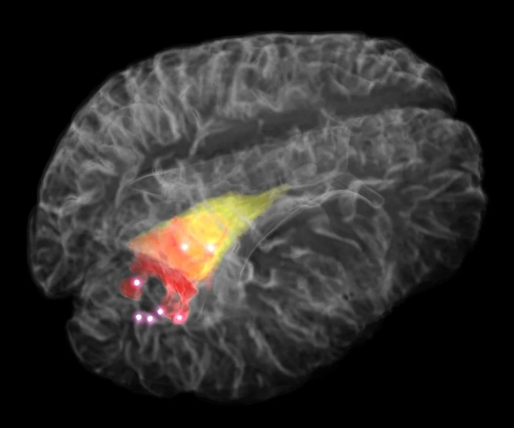 he image depicts a 3D rendering of the brain