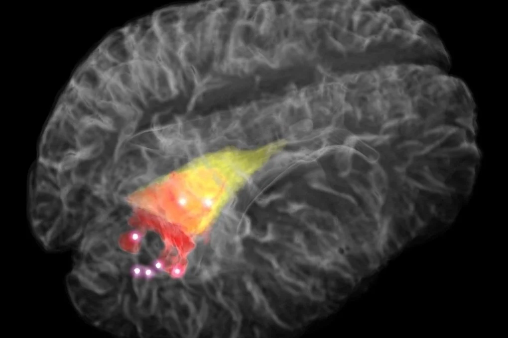 Fibre-optic device could advance brain tumour surgery