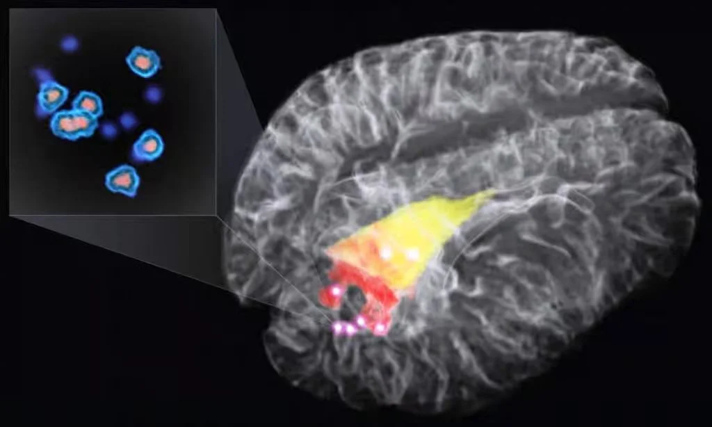 New Raman Spectroscopy Probe Could Improve Outcomes In Brain Cancer Surgery