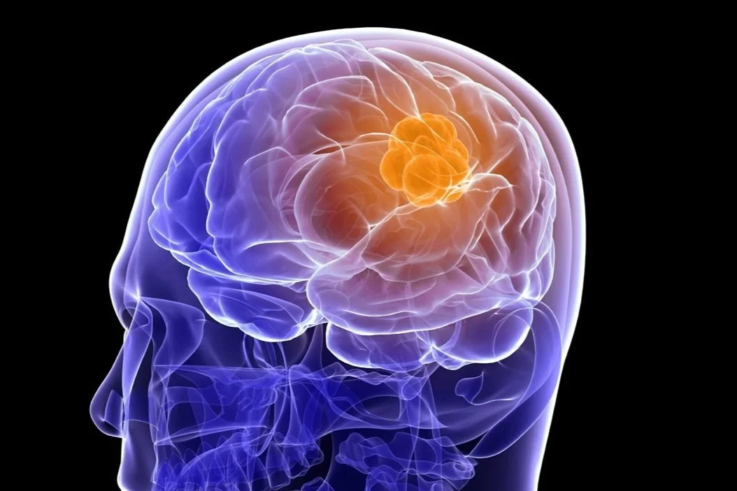 Nouvel outil contre le cancer du cerveau