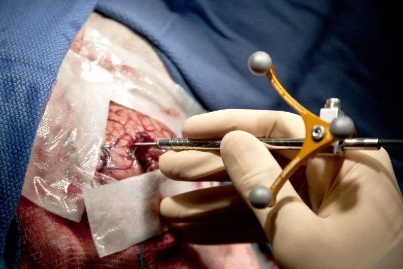 Percée dans l’ablation des tumeurs au cerveau