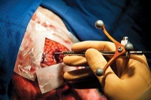 Raman Technique Helps Surgeons Excise Brain Cancer