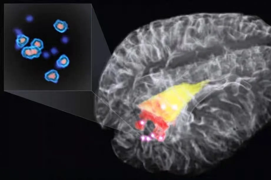 3D rendering of the brain