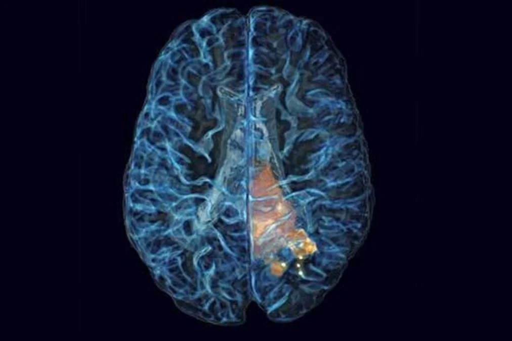 surgical tool improves outcomes for brain cancer patients